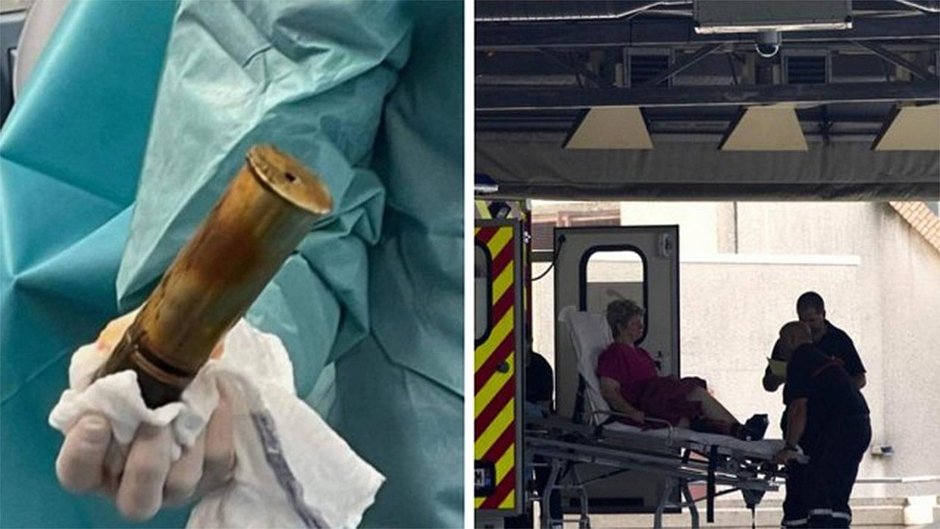 Homem dá entrada em hospital com bomba de 18 cm no reto
