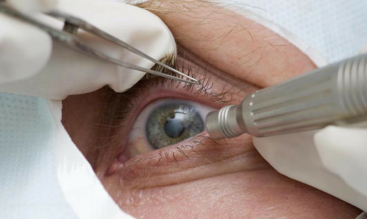 Entidades exigem regras sanitárias em mutirões de oftalmologia