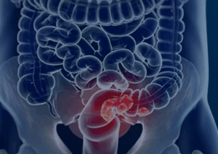 Mortes por câncer colorretal devem aumentar 36% até 2040