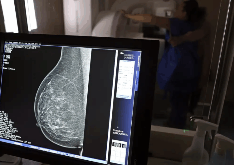Falta de acesso a mamógrafos limita prevenção do câncer de mama
