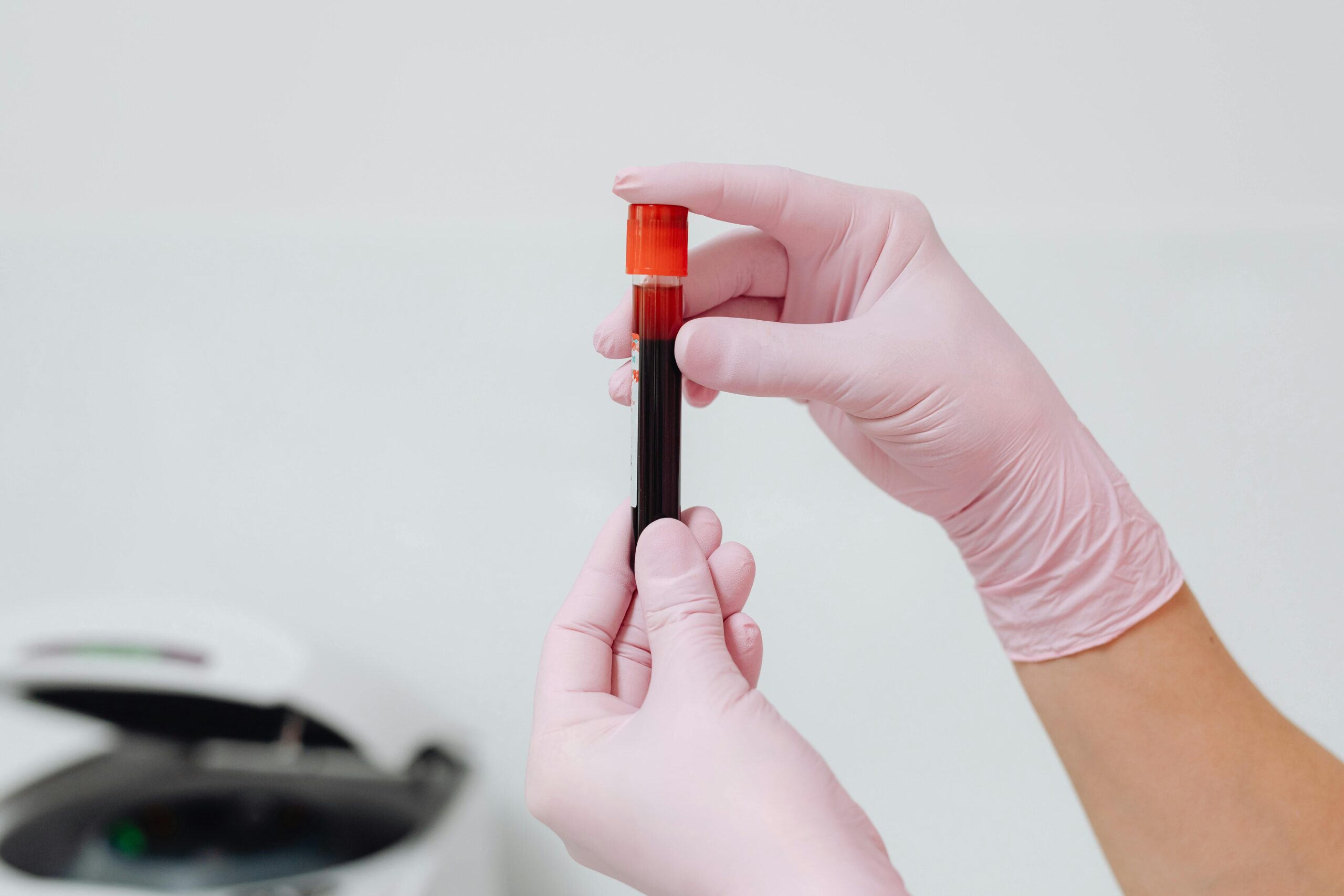 Exame de sangue amplia chance de detectar câncer de pâncreas em estágios mais precoces